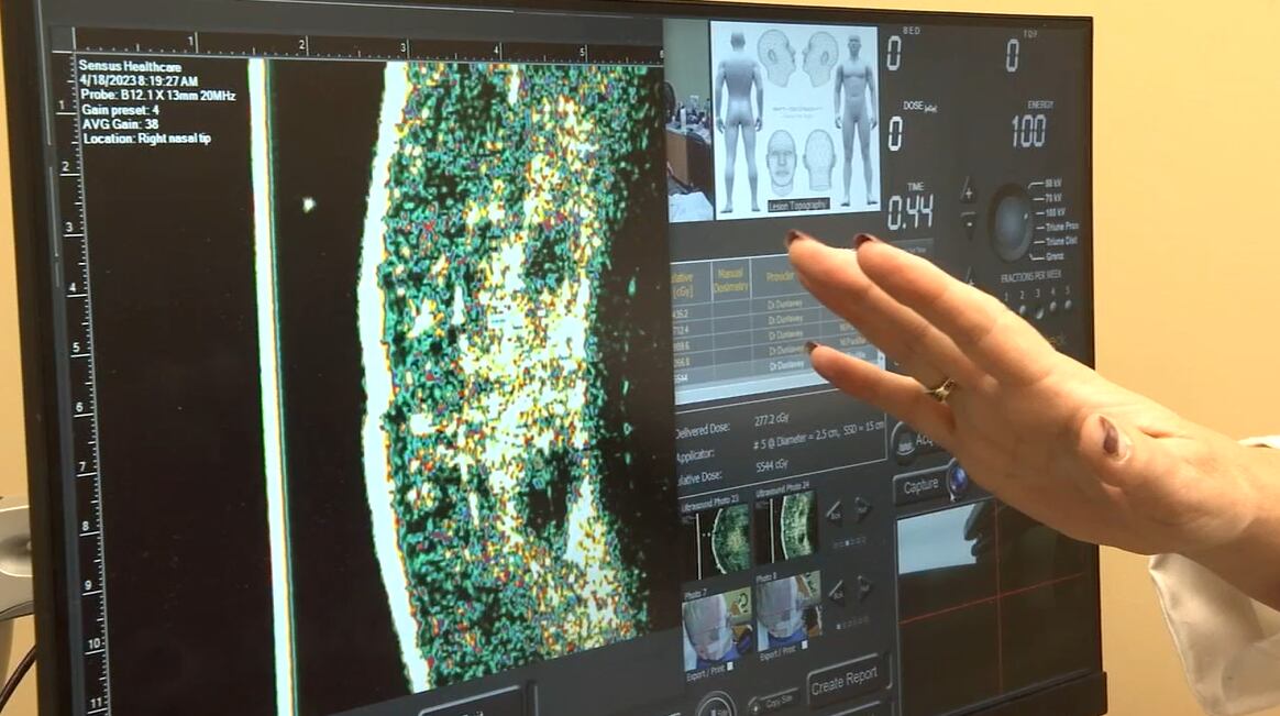 Skin cancer treatment in the Upstate involves no surgery, pain or scarring - Vimarsana News